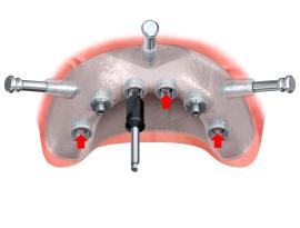 Zahersatz computernavigiert, Implantologie, Computernavigierte Implantologie, Implantat Zähne