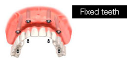 Fixed teeth