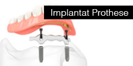 Implantat Prothese