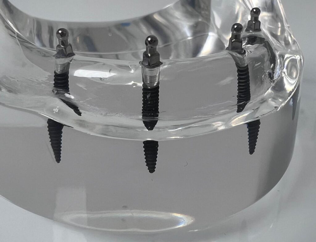 Totalprothese auf Miniimplantaten